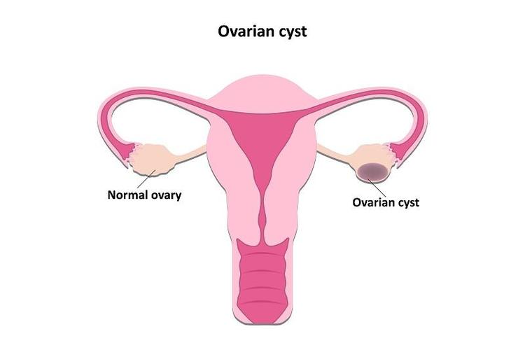 Can an Ovarian Cyst Be Normal